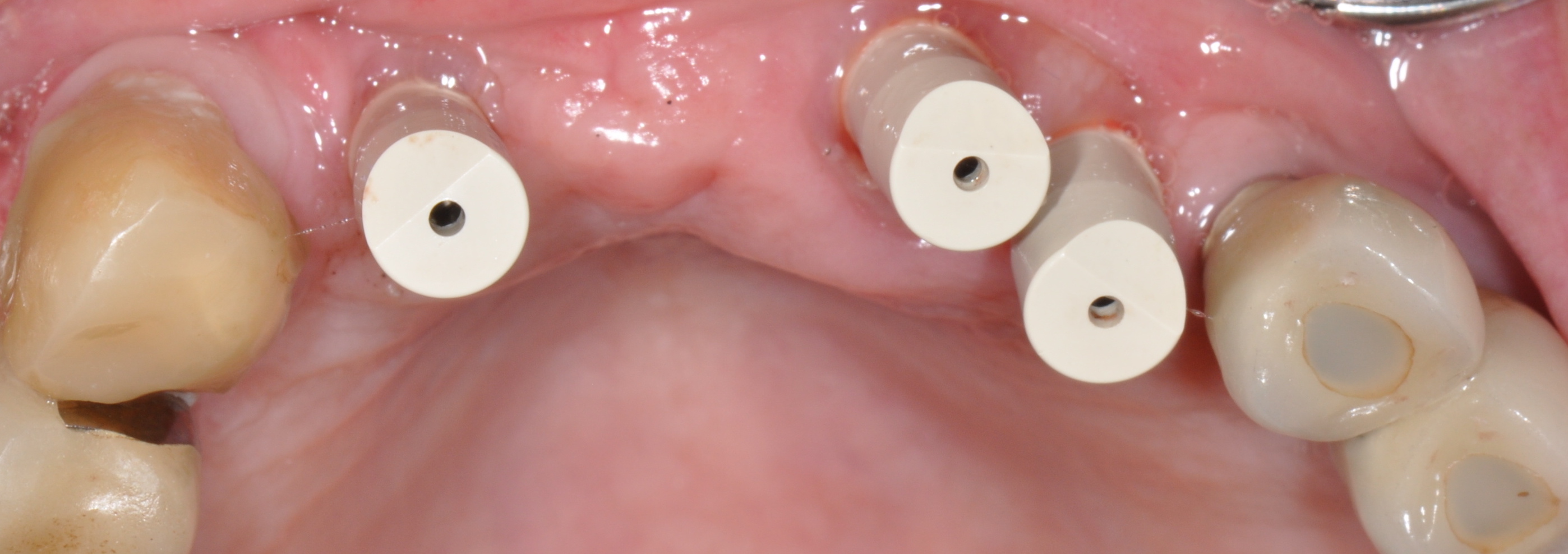 Clinical case kisch4